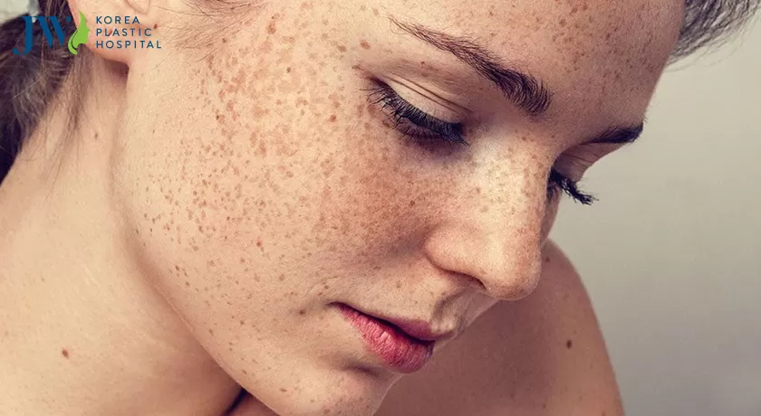 Điều trị nám da phải biết nguyên nhân hình thành