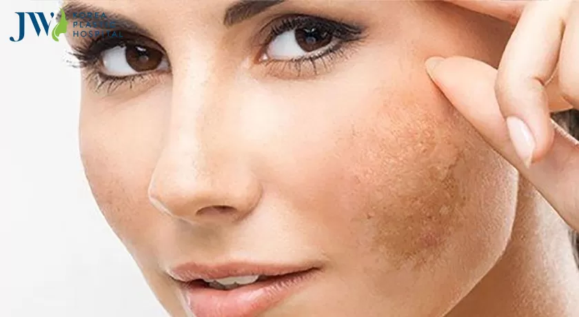 Cách trị nám da tại nhà bằng các phương pháp cực kì dễ thực hiện