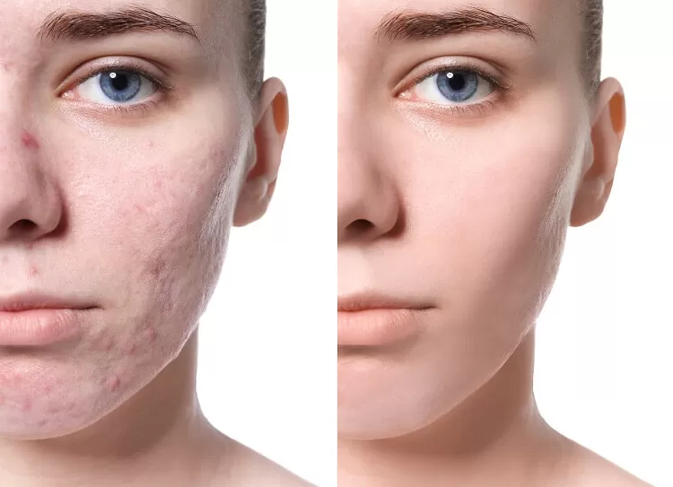 Cách trị sẹo rỗ, lõm lâu năm ngay tại nhà đơn giản và hiệu quả