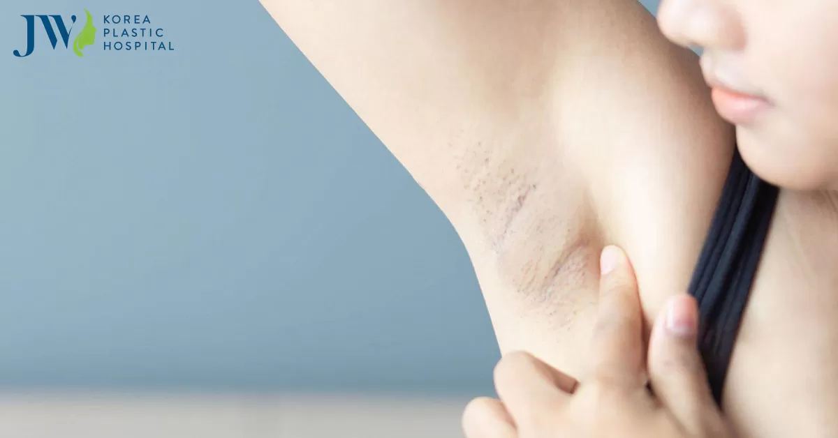 Cách tẩy triệt lông nách tại nhà với nguyên liệu từ thiên nhiên cực hiệu quả