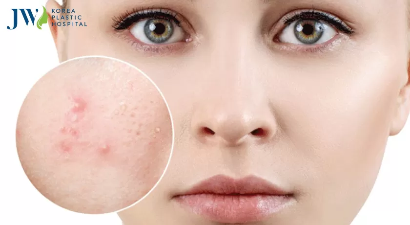 Cách trị sẹo lõm lâu năm ngay tại nhà trên mặt bằng hành tây
