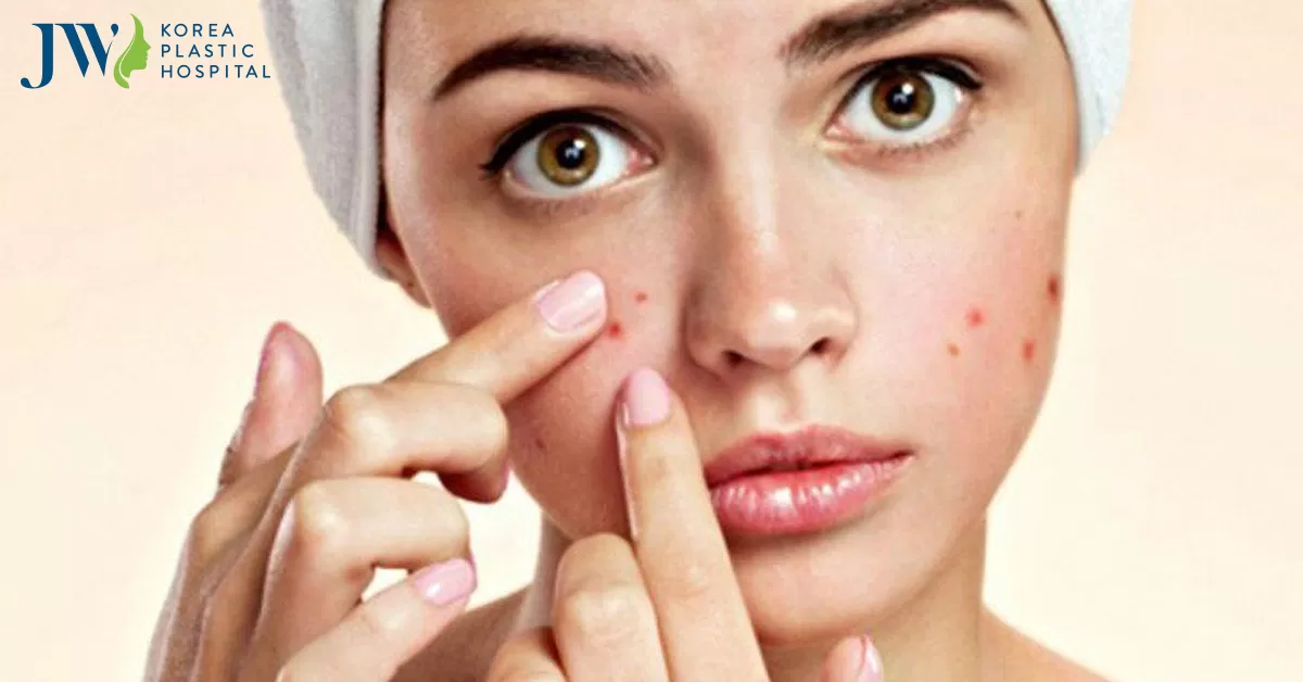 Cách trị mụn bằng mật ong an toàn hiệu cao ngay tại nhà