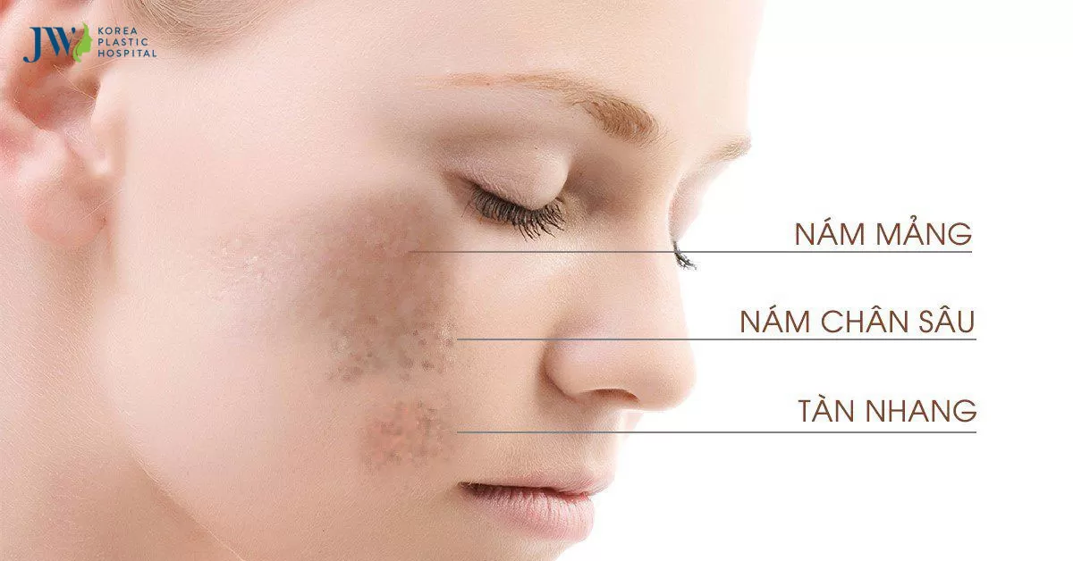 Cách trị nám bằng lá tía tô – Bài thuốc từ ngàn xưa