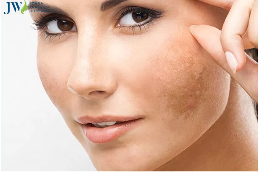 Cách trị nám bằng lá tía tô có thực hư ra sao?