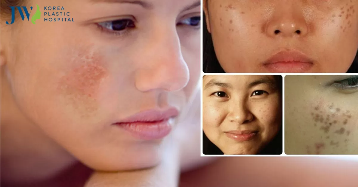 Cách trị tàn nhang tận gốc vừa túi tiền bằng nguyên liệu từ thiên nhiên