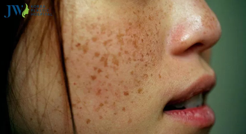 Cách trị tàn nhang tận gốc vừa túi tiền bằng nguyên liệu từ thiên nhiên