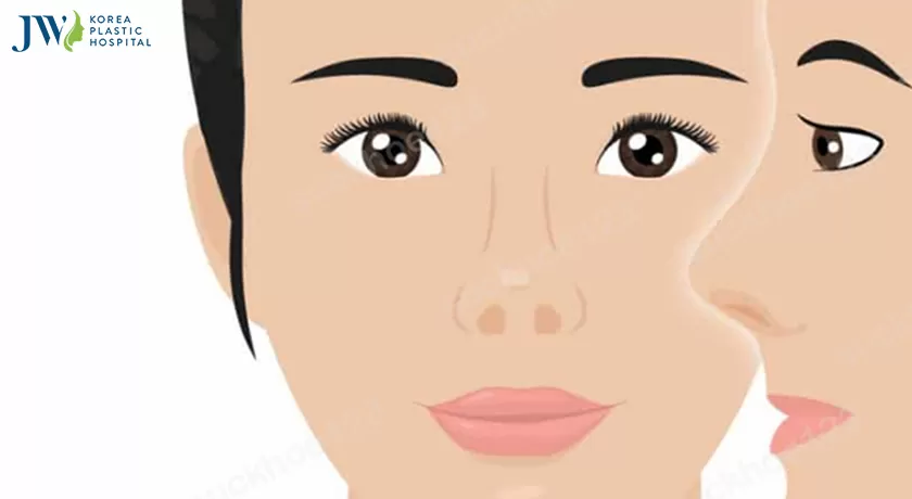 Mũi hếch là gì? Vận mệnh người mũi hếch thế nào? Làm sao khắc phục?