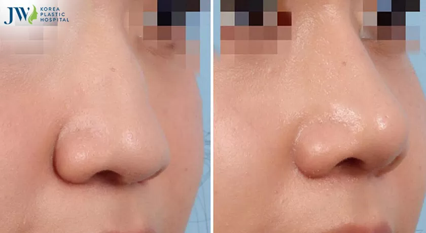Nâng mũi bằng sụn tai an toàn, khắc phục biến chứng