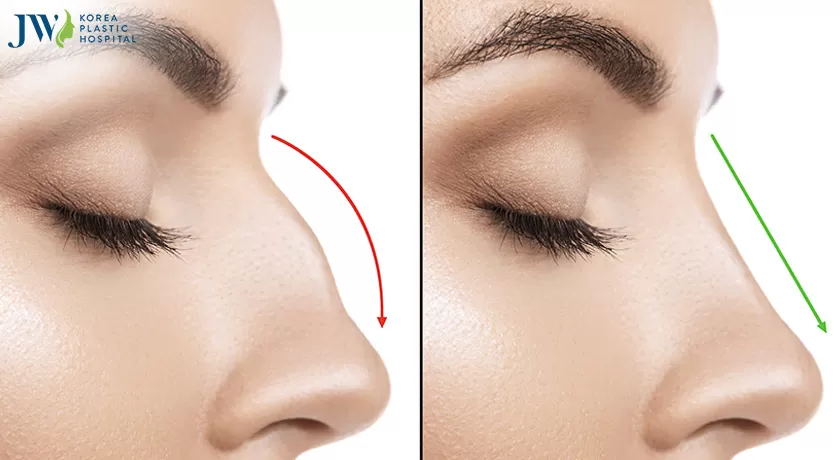 Nâng mũi bằng sụn tai có tốt không