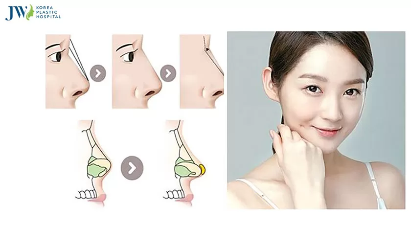 Nâng mũi bằng sụn vách ngăn 