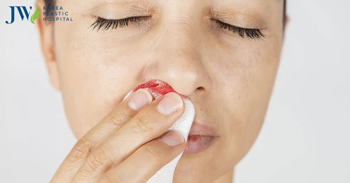 Nâng mũi bị chảy máu do đâu? Cách ngăn ngừa chảy máu sau nâng mũi