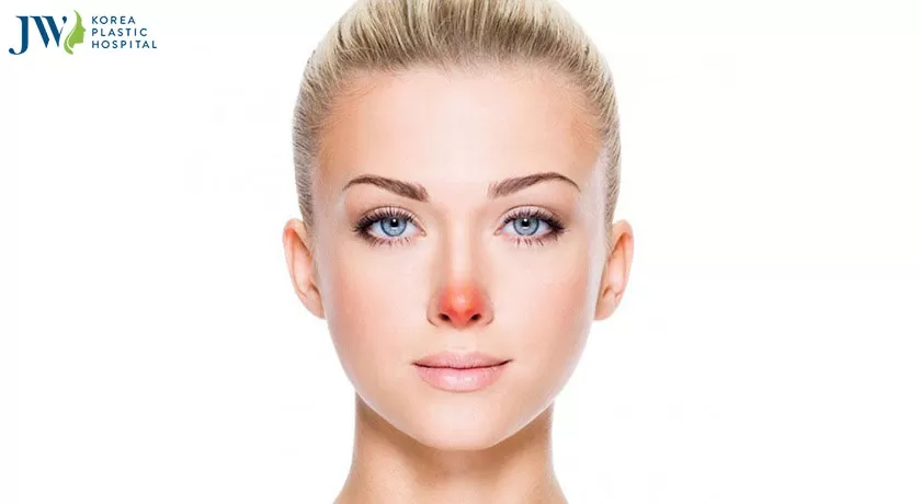 Nâng mũi bị đỏ đầu mũi? Nguyên nhân do đâu và khắc phục
