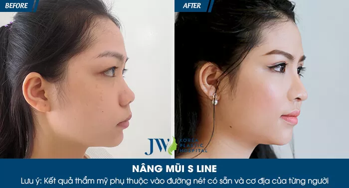 Nâng mũi có thay đổi khuôn mặt không? Sự khác biệt trước và sau khi nâng mũi