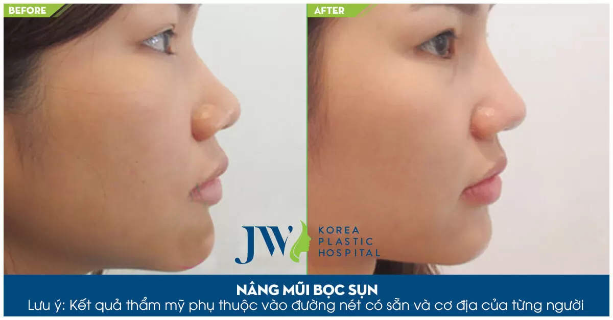 Nâng mũi ở đâu vĩnh viễn trọn đời?