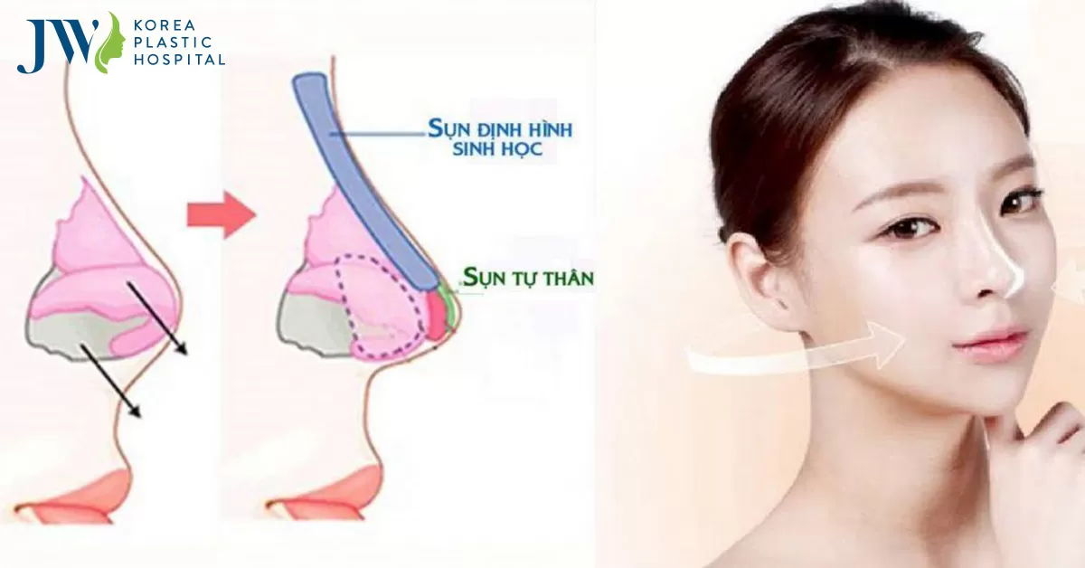 Nâng mũi sụn nhân tạo giữ được bao lâu? Lưu ý khi làm mũi sụn nhân tạo