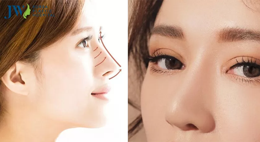 Nên cắt mắt trước hay sửa mũi trước? Cùng nghe giải đáp từ chuyên gia
