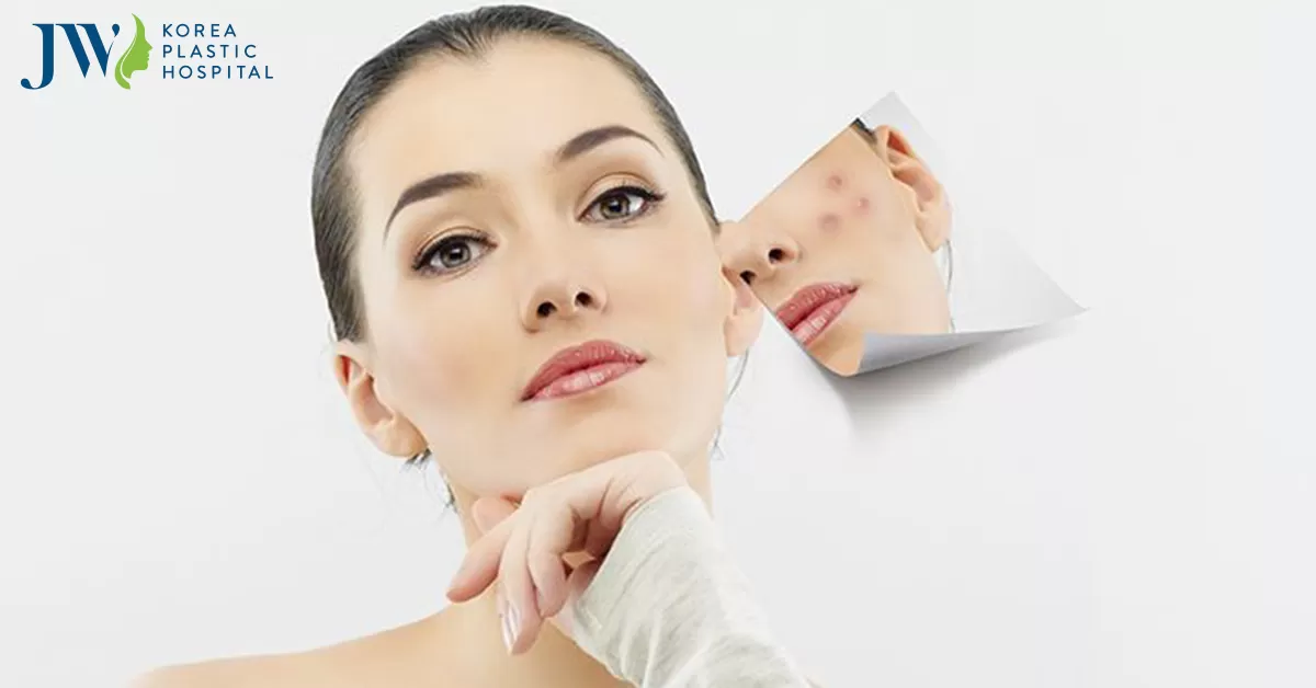Bật mí cách trị mụn đơn giản tại nhà hiệu quả bất ngờ