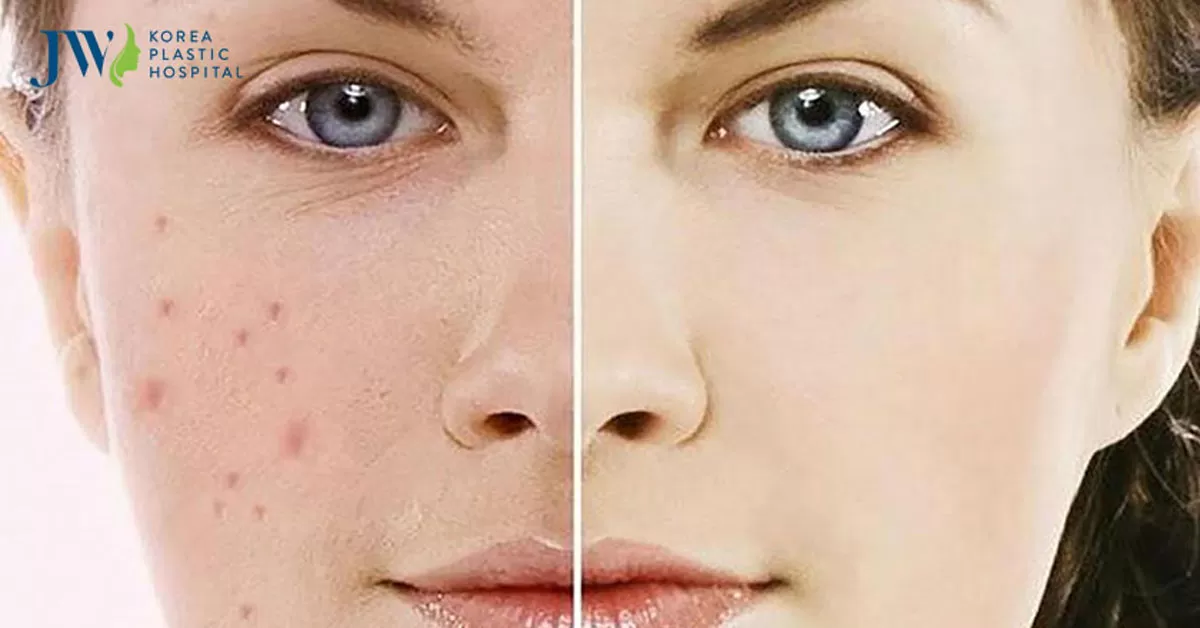 Cách trị thâm mụn hiệu quả cấp tốc tại nhà đọc ngay để tiết kiệm chi phí