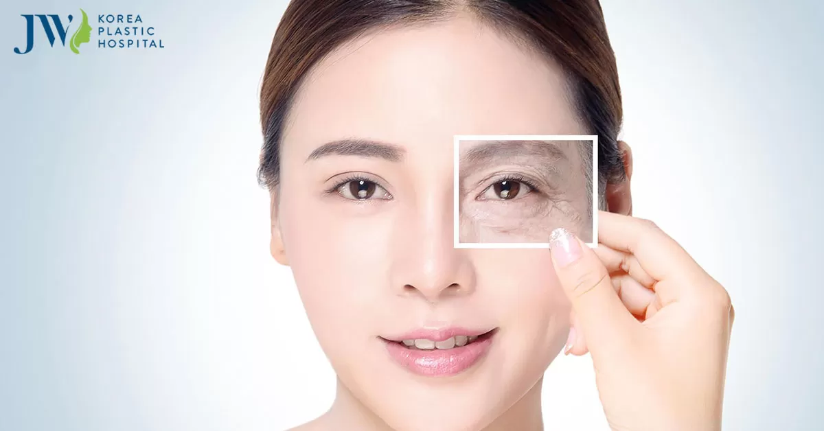 Cách xóa nếp nhăn vùng mắt tại nhà thử ngay trẻ ra 10 tuổi