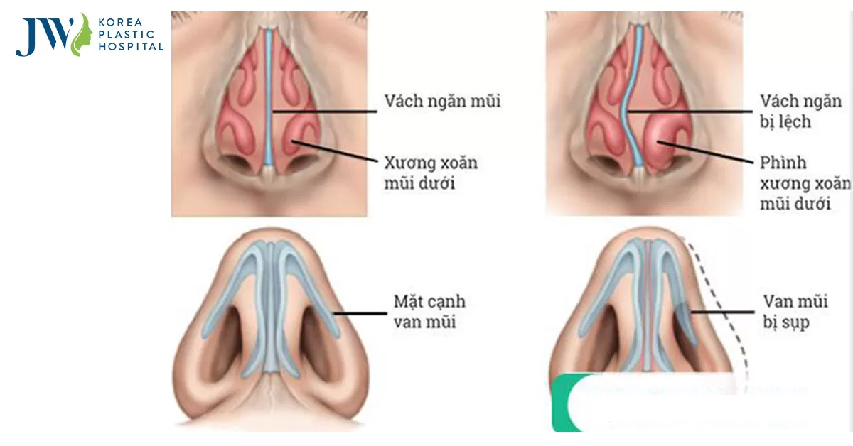 Mũi lệch, vẹo vách ngăn khi nào thì cần mổ để chỉnh lại dáng mũi?