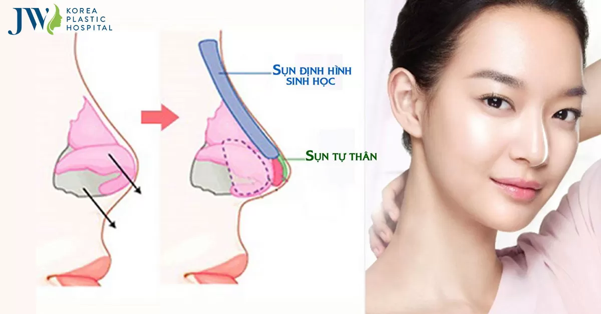 Nâng Mũi Bọc Sụn – Xua Tan Nỗi Lo Mũi Bóng Đỏ Lộ Sóng