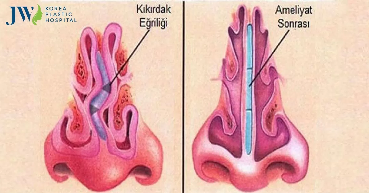 Vẹo vách ngăn mũi có ảnh hưởng nghiêm trọng đến sức khỏe không?