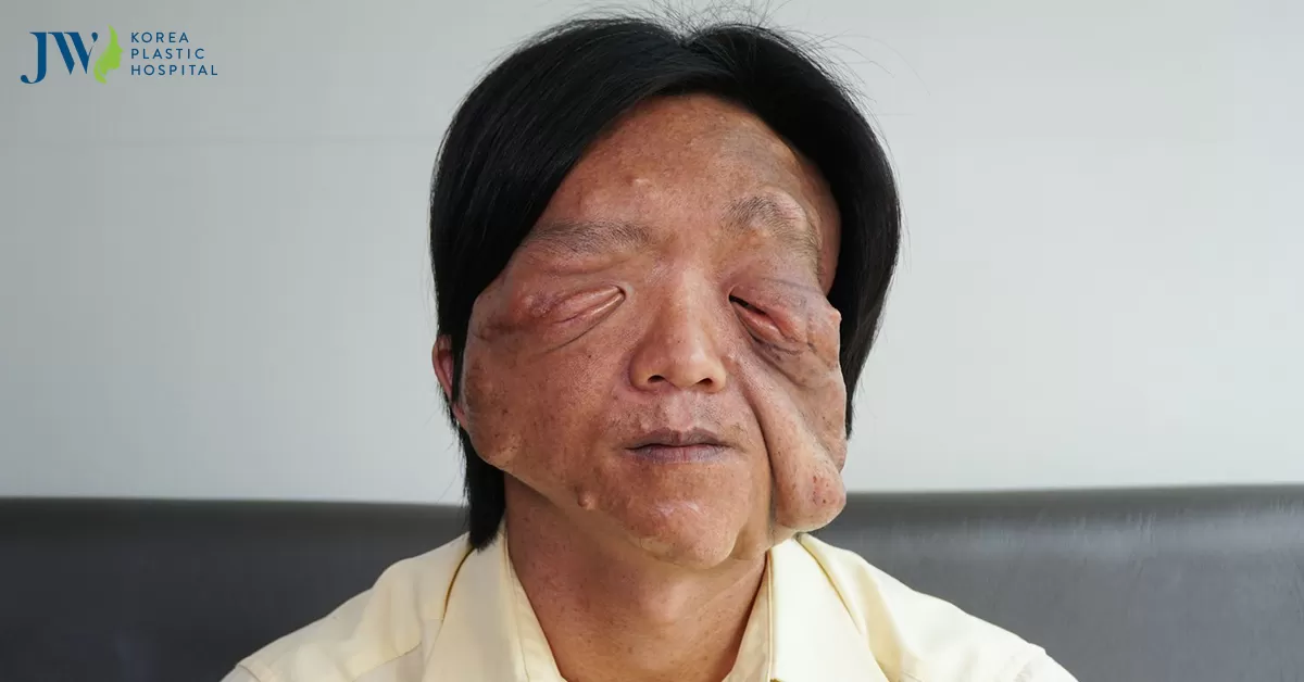 Câu chuyện về Pu- chàng trai nghèo bị mắc bệnh u sợi thần kinh