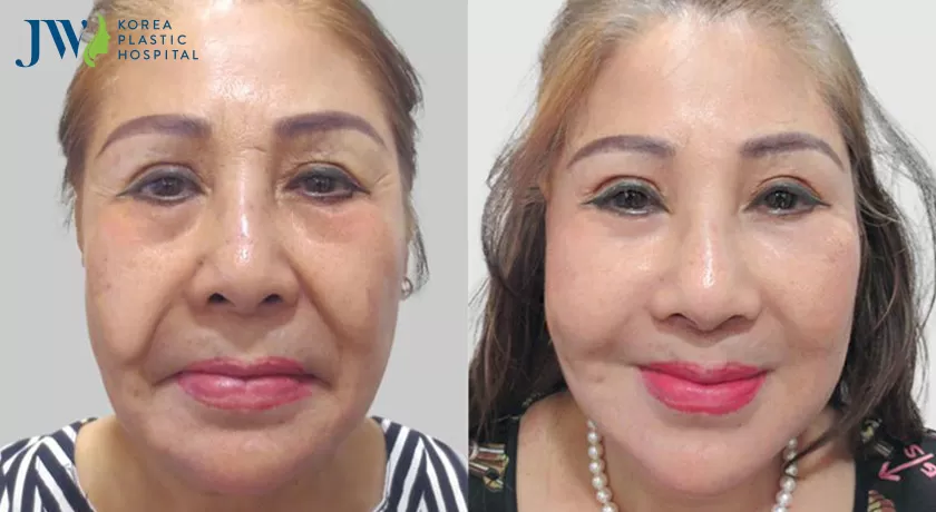 cải lão hoàn đồng như lời đồn