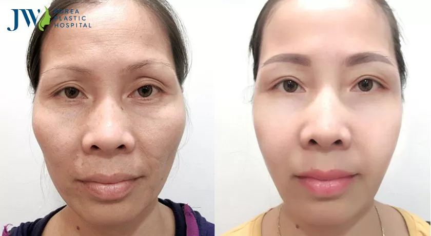mẹo khắc phục gương mặt già trước tuổi