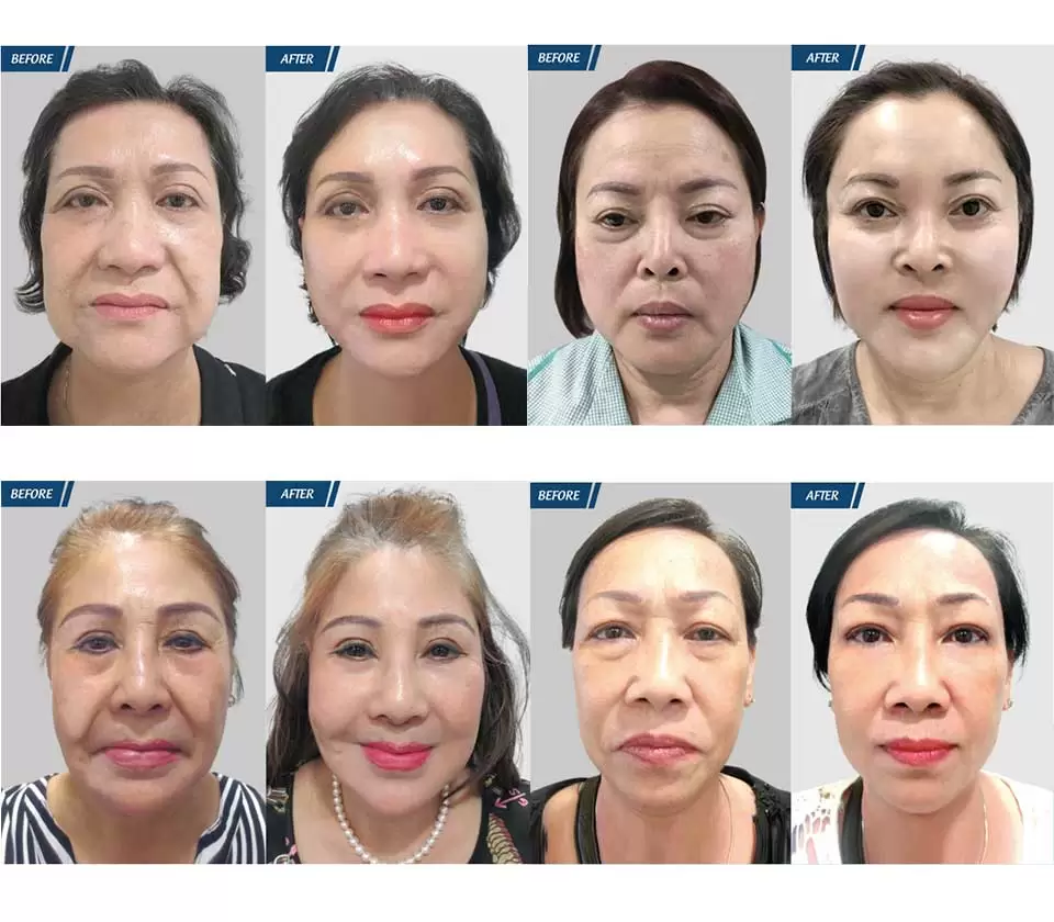 Cải lão gương mặt 3M bao lâu thì đẹp