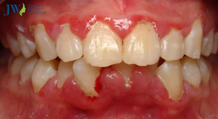 tác dụng làm trắng răng của kem đánh răng