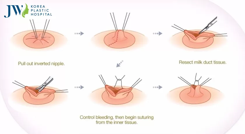 kéo núm vú bị tụt nhanh chóng