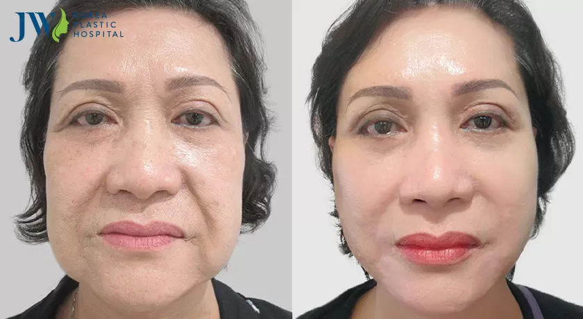 Lấy lại vẻ đẹp không tuổi cải lão gương mặt 3m