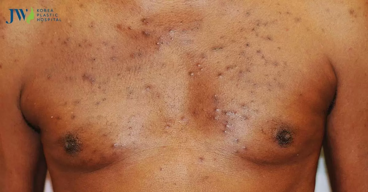 Mụn thịt ở ngực: Nguyên nhân và cách điều trị an toàn hiệu quả triệt để