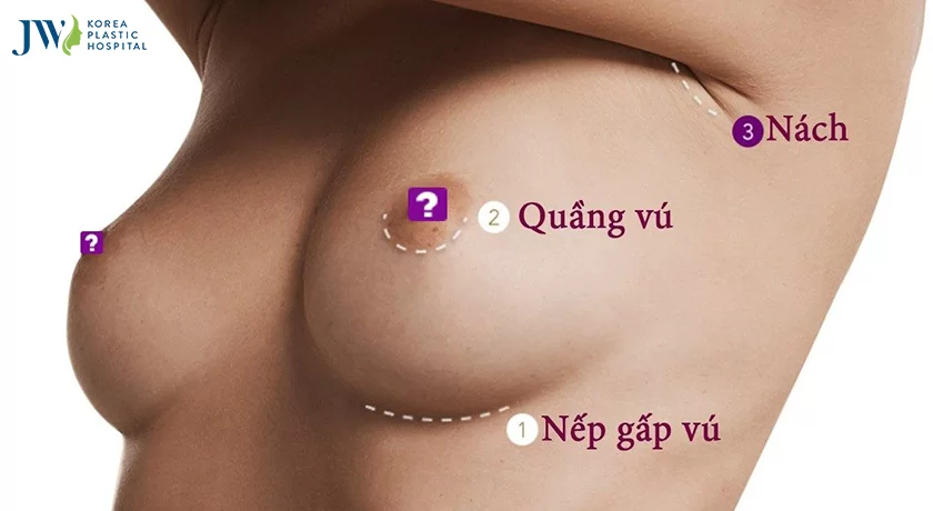 nâng ngực giá bao nhiêu tiền