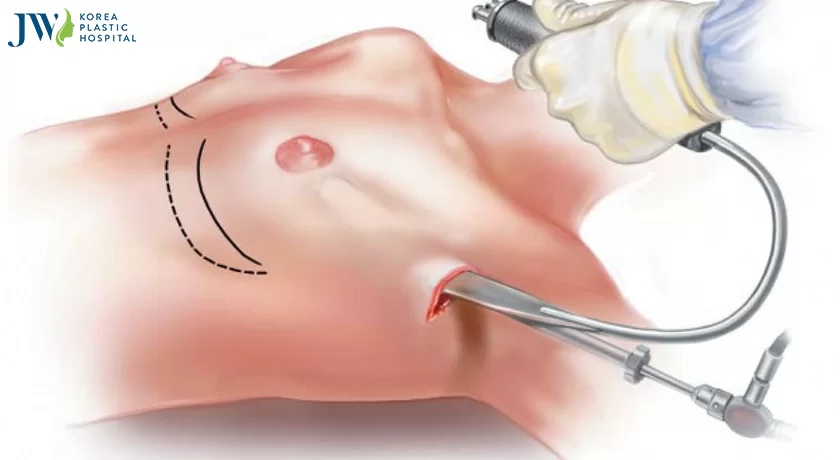 Nâng ngực nội soi có an toàn không