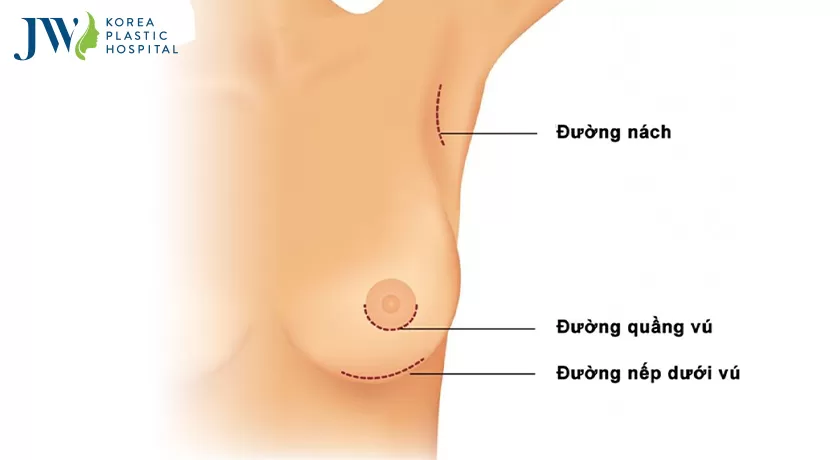 Các đường mổ trong thẩm mỹ ngực bằng kỹ thuật nội soi