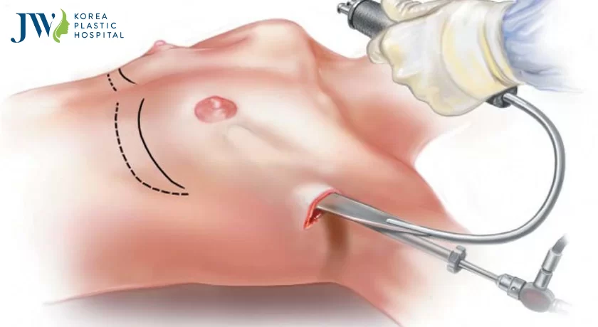 Nâng ngực nội soi đường nách và những điều cần lưu ý khi thực hiện