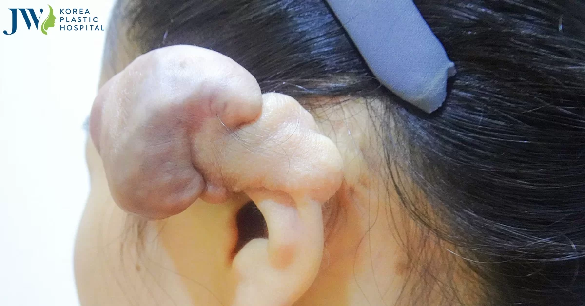 Đam mê xỏ 6 khuyên tai, mẹ trẻ gen Z phải cắt tai vì vành tai mọc khối u to hơn quả mận