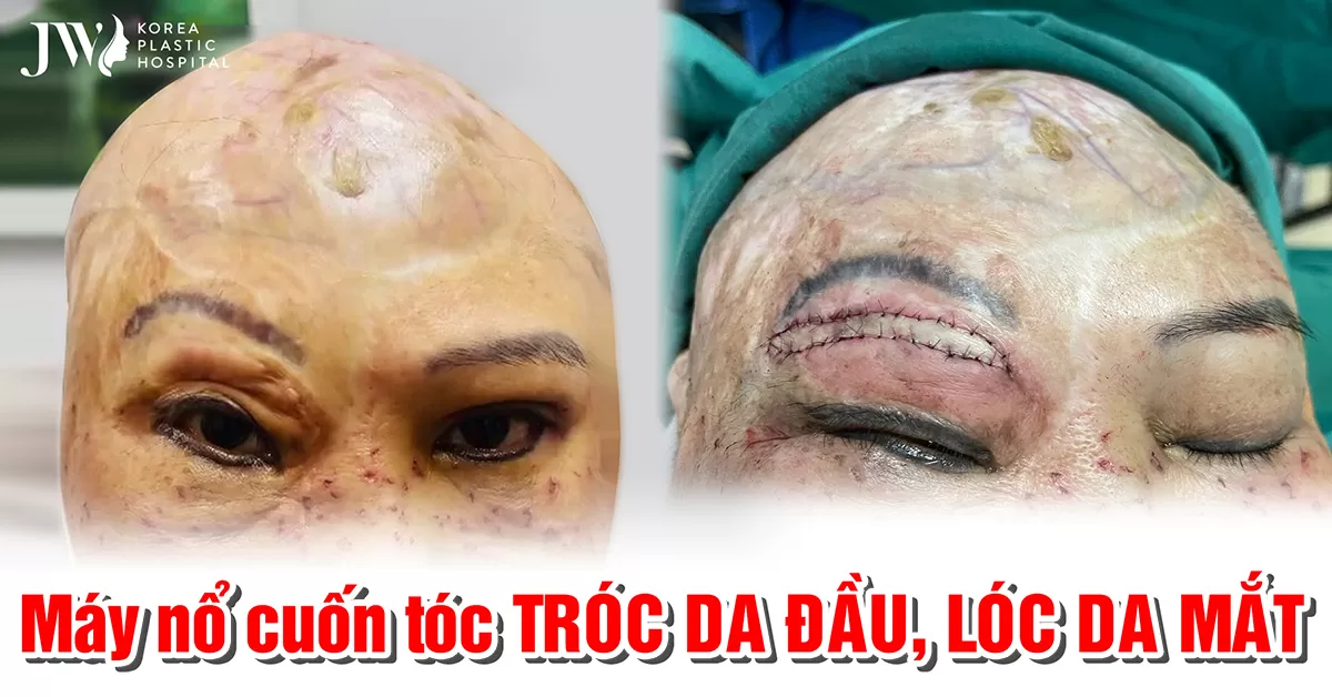 Người phụ nữ bị tróc toàn bộ da đầu do tóc cuốn vào máy nổ đang khởi động