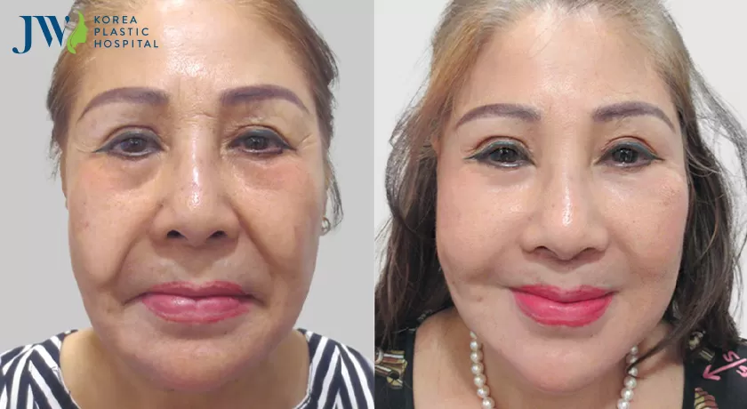 Cải lão gương mặt 3M tại bệnh viện JW có ưu nhược điểm gì?
