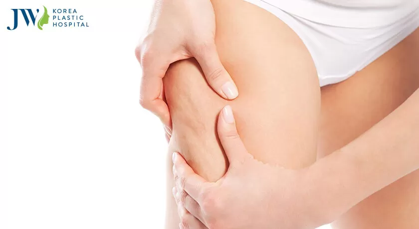 căng da đùi chảy xệ