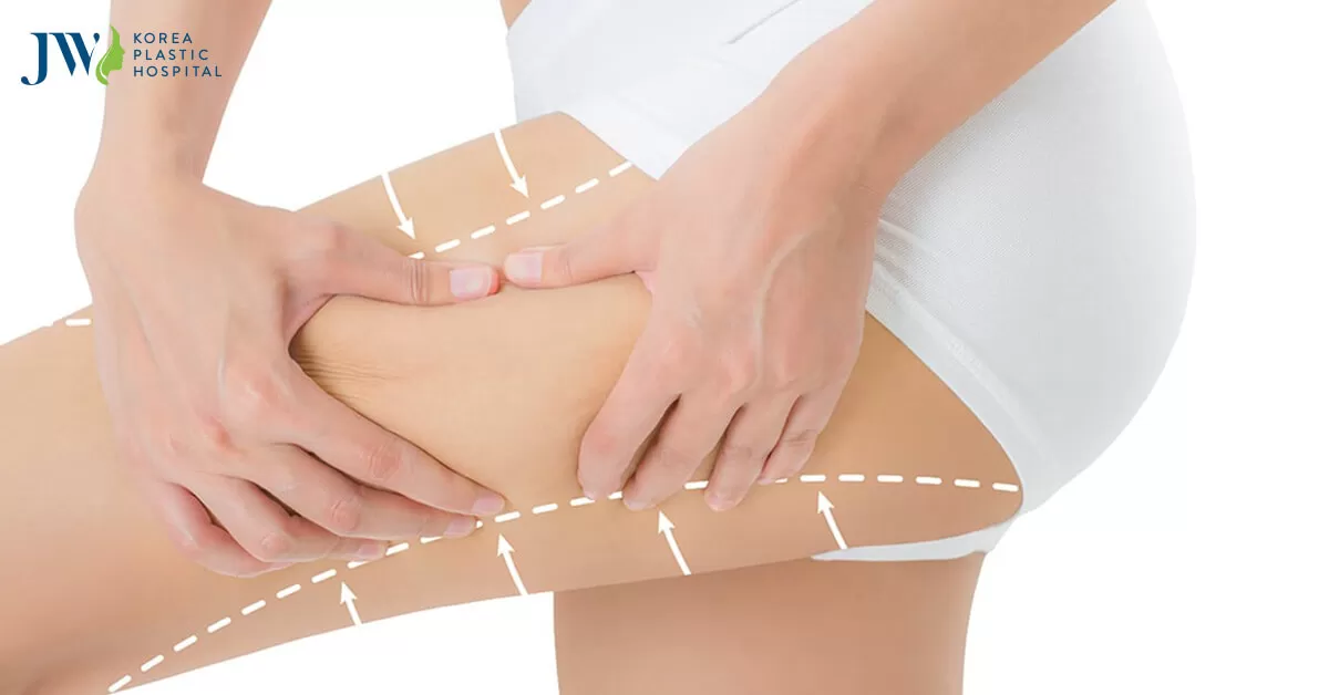 Căng da đùi thẩm mỹ – Thon gọn, săn chắc tức thì