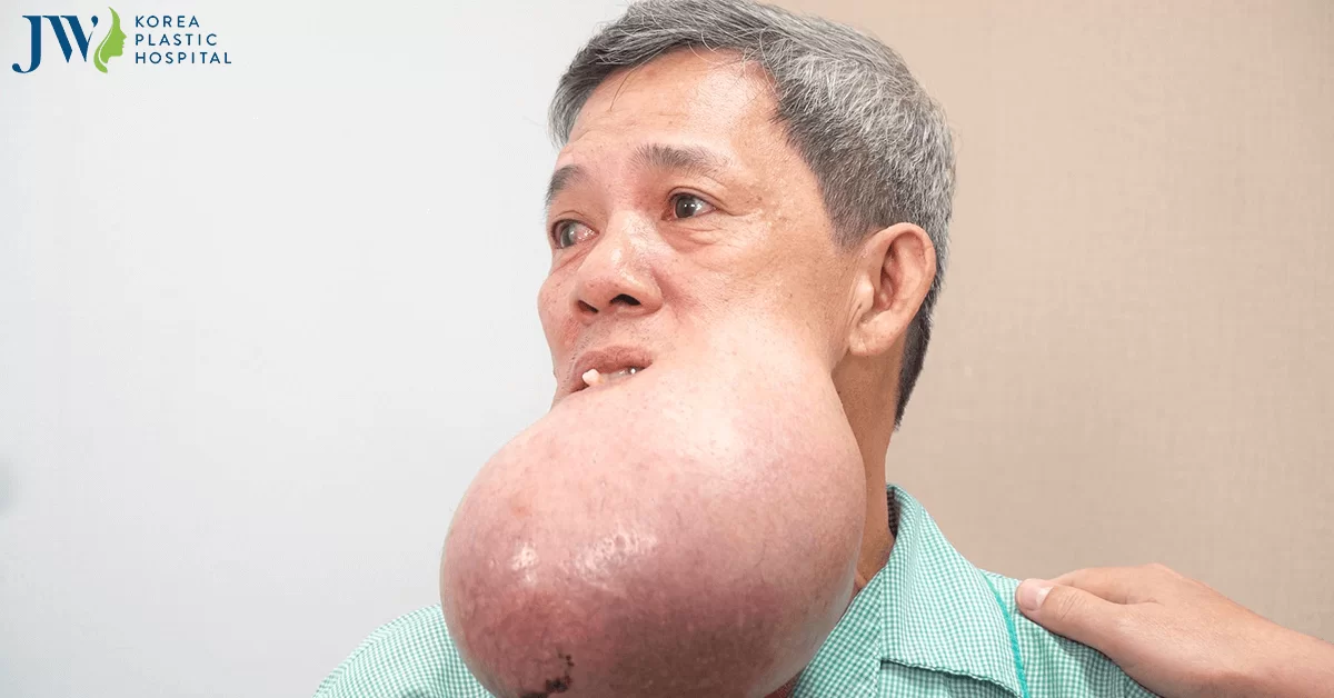 Cuộc đua tìm đường phẫu thuật khẩn cấp cho người đàn ông có khối u khổng lồ