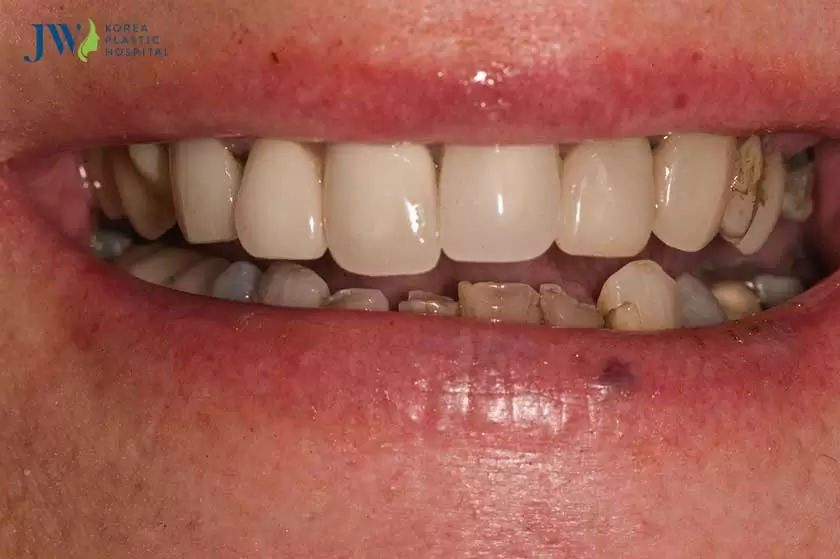 bọc răng sứ dỏm