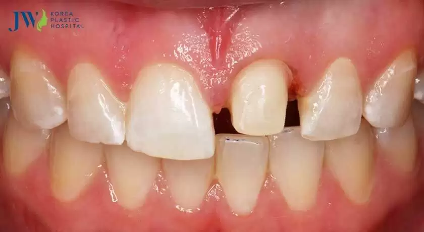 bọc răng sứ hư răng thật