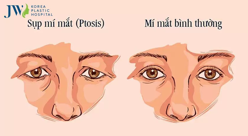 cách chữa sụp mí tại nhà