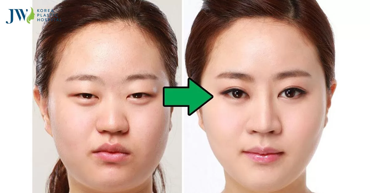 Cách chữa sụp mí tại nhà đơn giản không để lại biến chứng
