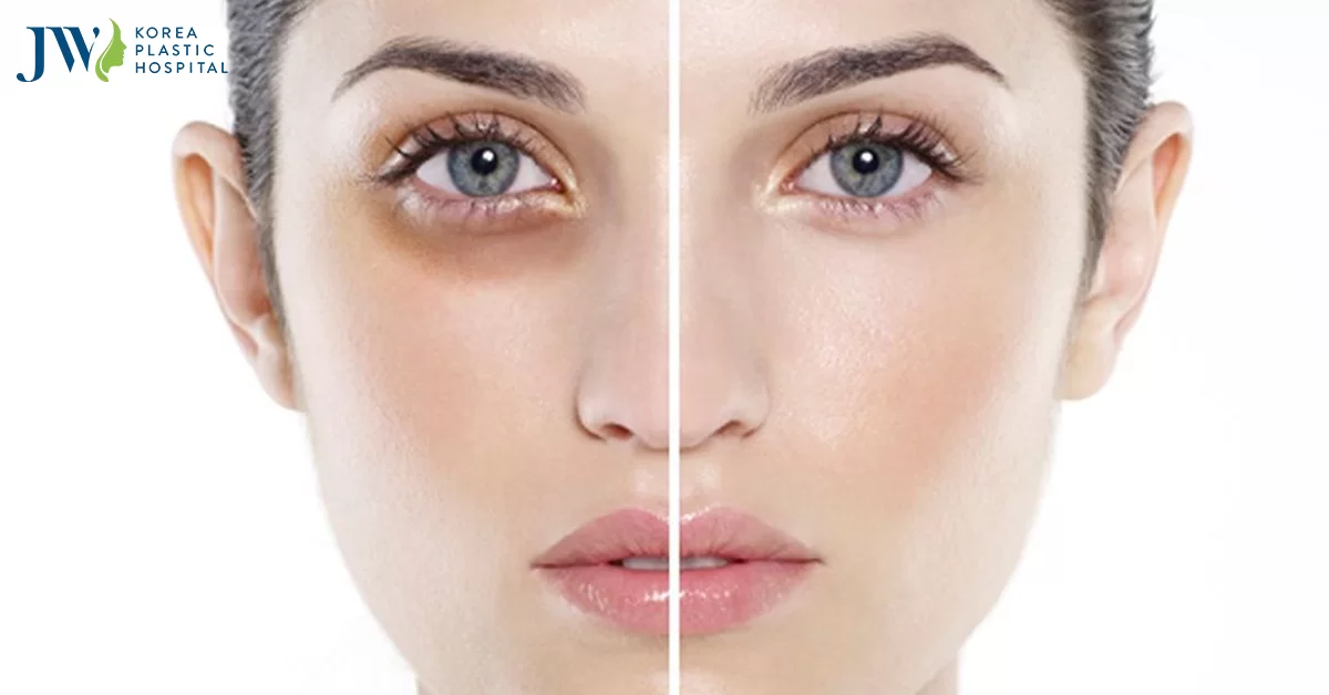 Cách trị bọng mắt dưới hiệu quả mà không phải ai cũng biết