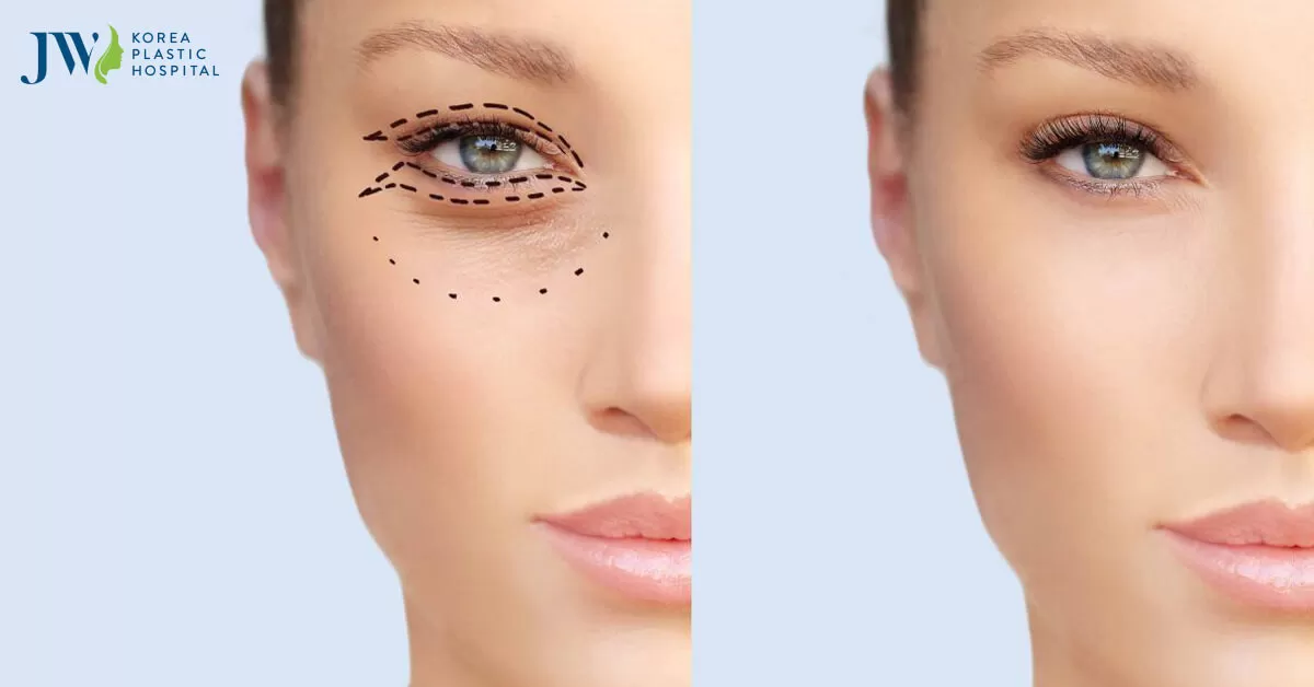 Hướng dẫn cách giảm sưng hiệu quả sau khi cắt mí mắt